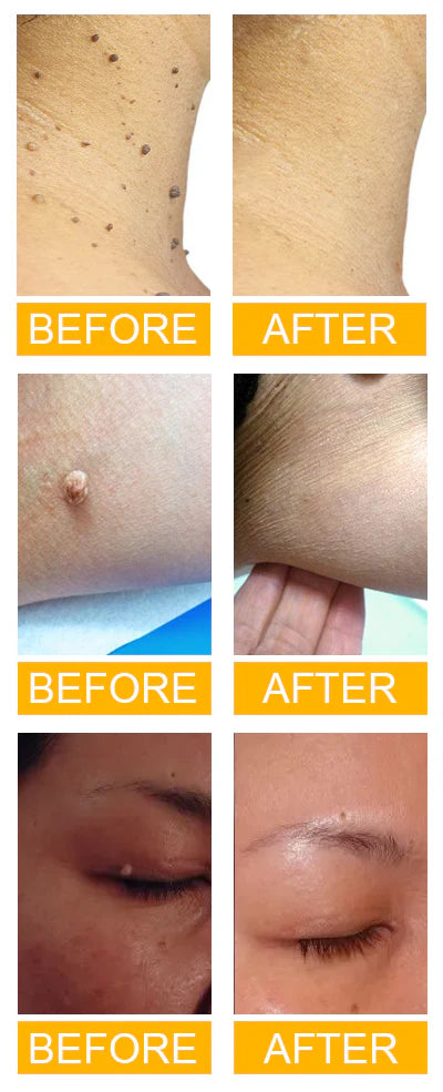 Skin Tag Eraser