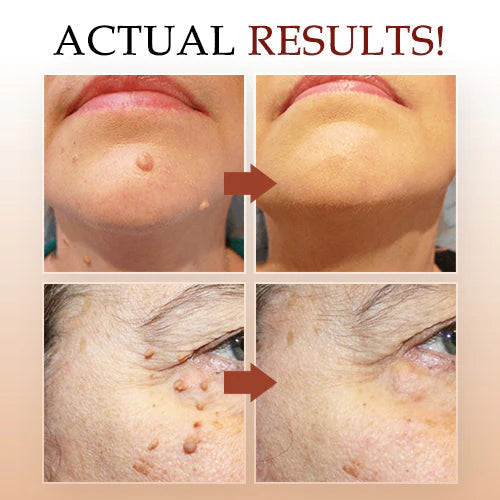 Dermoso Skin Tag & Moles Remover Buy 1 Get 1 Free (Pack of 2)